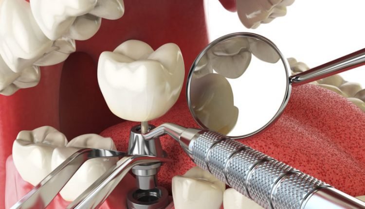 implanturi-dentare